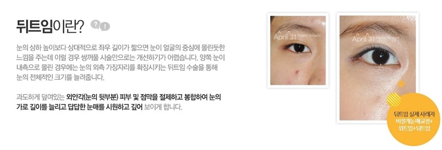 눈성형 때문에 고민이신가요? 관련 이미지 3