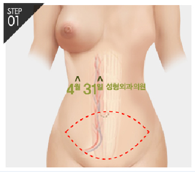 유방재건술 자신감 회복은 4월31일성형외과에서 관련 이미지 5