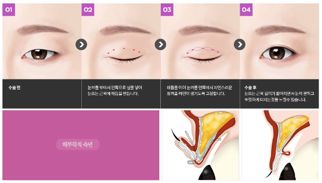 [Eye Plastic Surgery] Is male eye surgery always too feminine? Key points for male double eyelid surgery! image 6