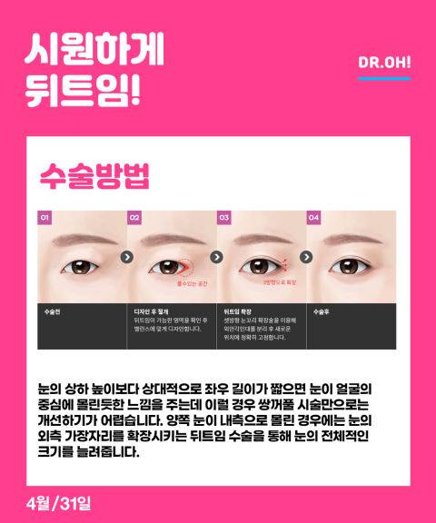 내게 꼭 맞는 눈트임수술 4월31성형외과 트윈클 트임 관련 이미지 4