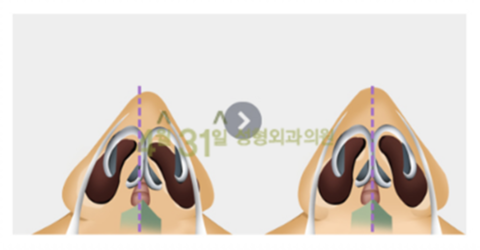 휜코수술잘하는곳 4월31일성형외과의원에서 바르게 관련 이미지 5