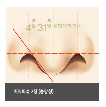 비공내리기 콧구멍교정 잘하는 4월31일성형외과의원에서 관련 이미지 3