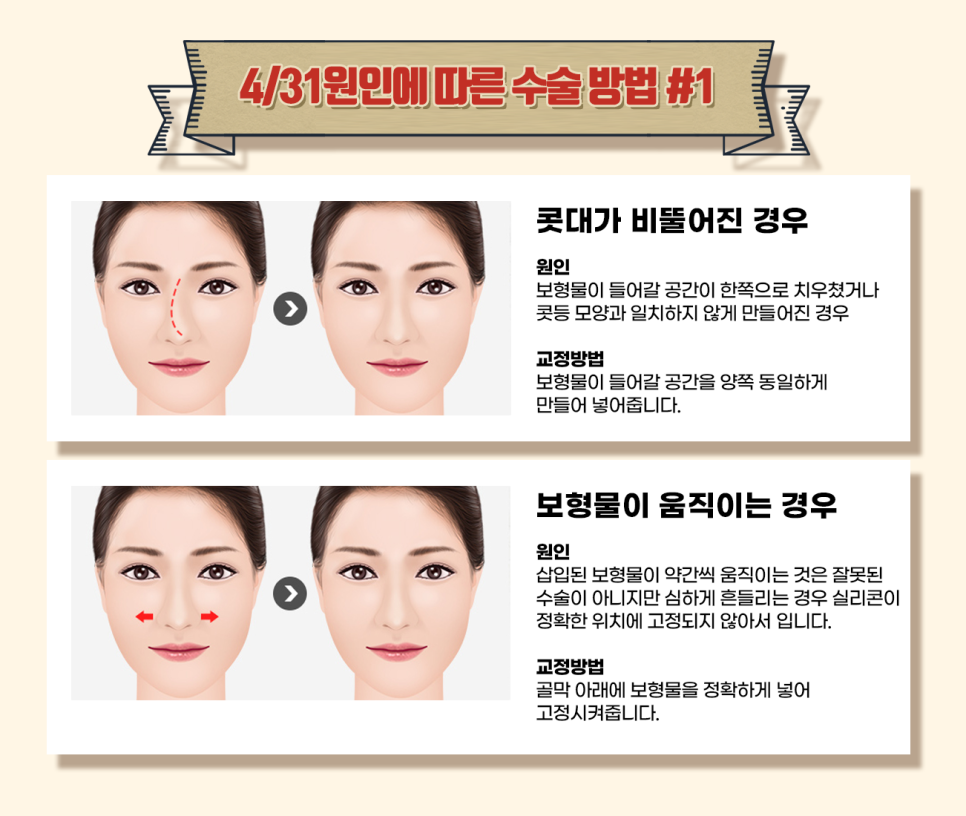 코재수술유명한성형외과 난이도 높은 코도 OK 관련 이미지 4