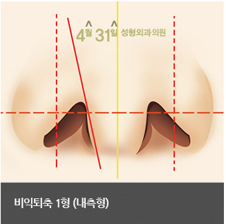 콧구멍성형 비익퇴축술 4월31일 성형외과의원에서 관련 이미지 4