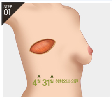유방재건술 자신감 회복은 4월31일성형외과에서 관련 이미지 4