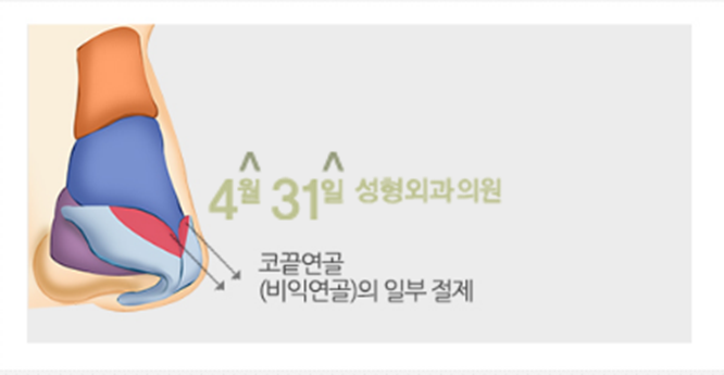 코성형잘하는곳 4월31일성형외과의원 긴코성형 관련 이미지 2