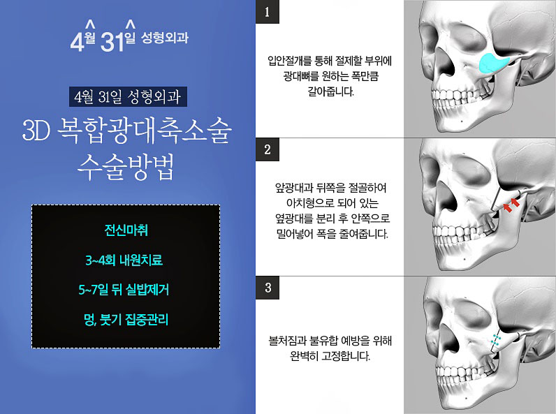 3D광대축소술 4월31일성형외과 믿음가는 곳! 관련 이미지 4