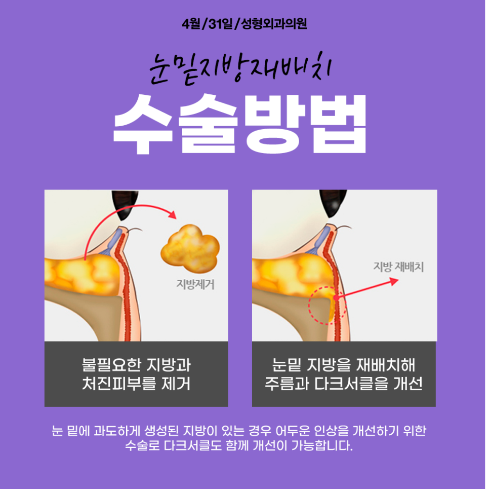 눈밑지방재배치성형외과에서 울퉁불퉁, 어두침침한 눈밑 이별해! 관련 이미지 2