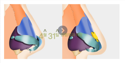 코끝성형 들리지 않게 4월31일성형외과의원 관련 이미지 4