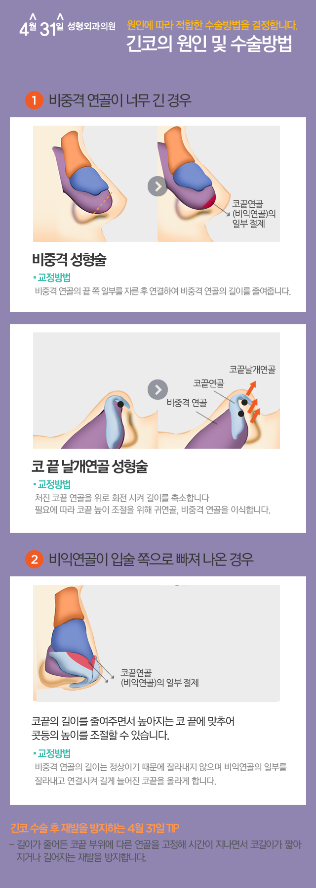 긴코성형 재발을 방지하는 4월31일성형외과 관련 이미지 2