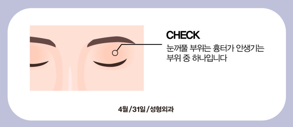 [Eye Surgery] Swelling and Scarring After Double Eyelid Surgery image 5