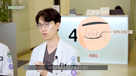 [눈성형] 내눈에는 어떤 방법이 최선일까? (매몰/절개/부분절개) 관련 이미지 2