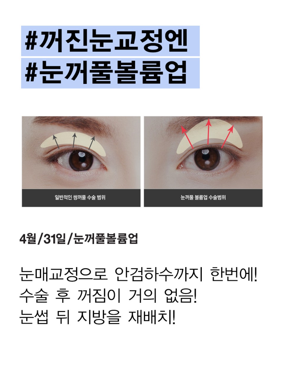 Let’s Improve Sunken Eyelids with Eyelid Volume Up for a More Vibrant Look :) image 3