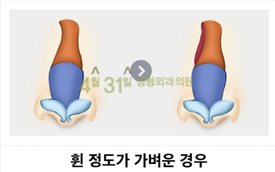 휜코교정잘하는곳 기능도 고려해야지 관련 이미지 3