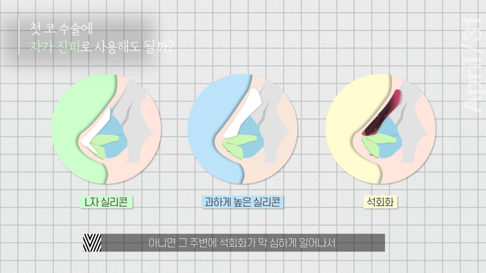 [코성형] 어디에서도 알려주지 않는 코성형에 대한 모든것 - 코수술 QnA Time! 관련 이미지 9