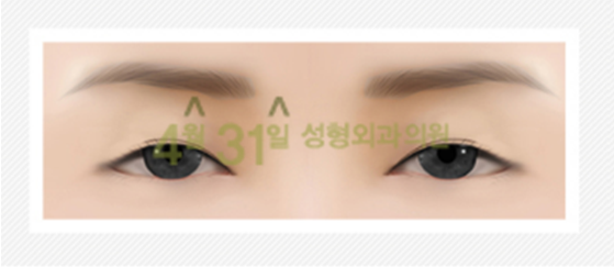 쌍커풀재수술 더이상은 없도록 4월31일성형외과 관련 이미지 3