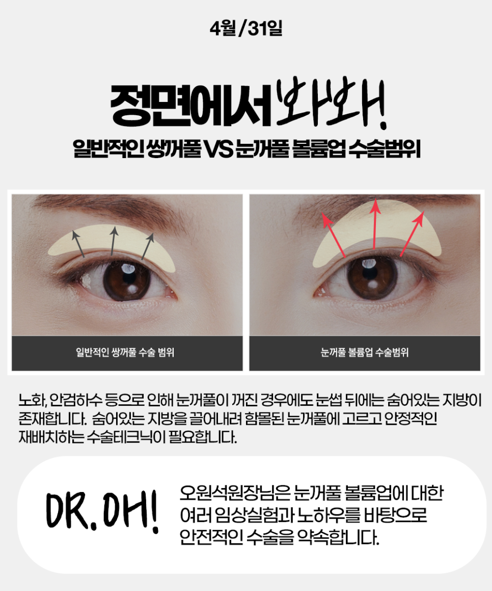 The Best Place for Midlife Eye Surgery: No More Worrying About Sagging Eyelids! image 6