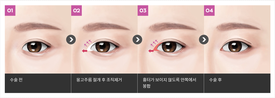 앞트임병원 추천 4월31일성형외과의원 관련 이미지 3