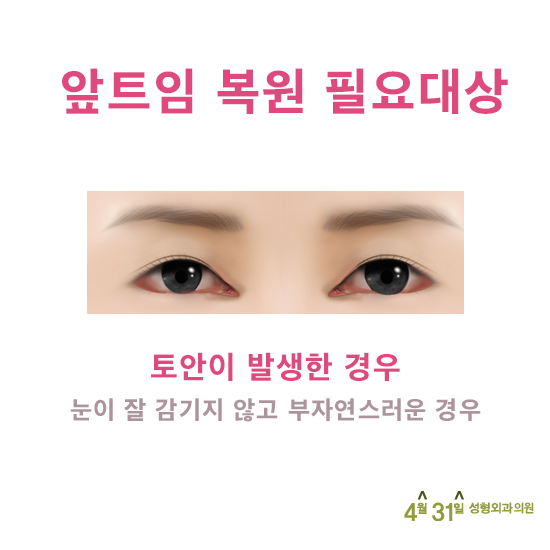 앞트임재건후기 추천병원 4월31일성형외과의원 관련 이미지 3
