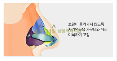 들창코수술 4월31일성형외과의원에서 자연스럽게 관련 이미지 3