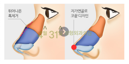 매부리코수술잘하는병원 고민하고 계신가요? 관련 이미지 6