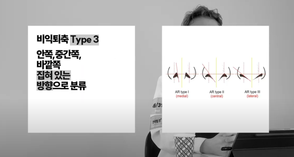[4월31일성형외과] 코성형 실리콘 보형물, 구축 올까요? 관련 이미지 4