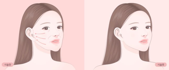 How to Get the Most Out of a Thread Lift + Self-Diagnosis Method image 2
