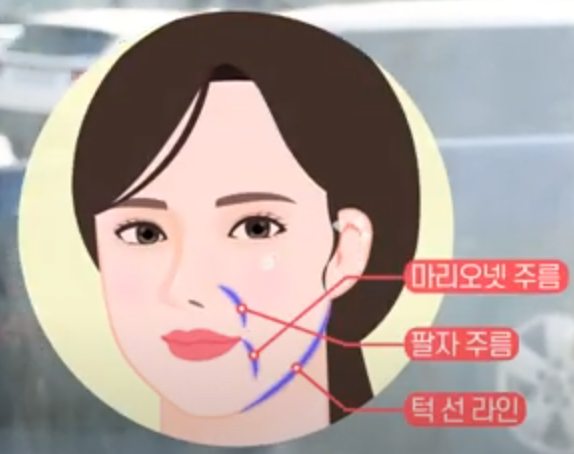 How to Get the Most Out of a Thread Lift + Self-Diagnosis Method image 5
