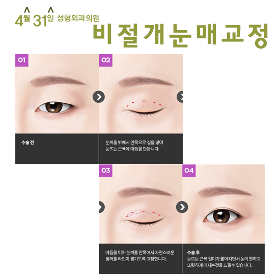 비절개눈매교정전후 비교해보면 4월31일성형외과의원 관련 이미지 4