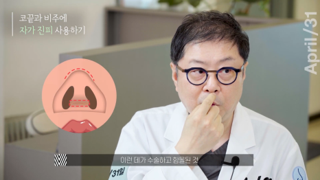 [코성형] 어디에서도 알려주지 않는 코성형에 대한 모든것 - 코수술 QnA Time! 관련 이미지 14