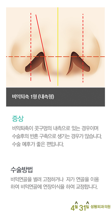 콧구멍수술 비익퇴축술 4월31일성형외과의원 관련 이미지 2