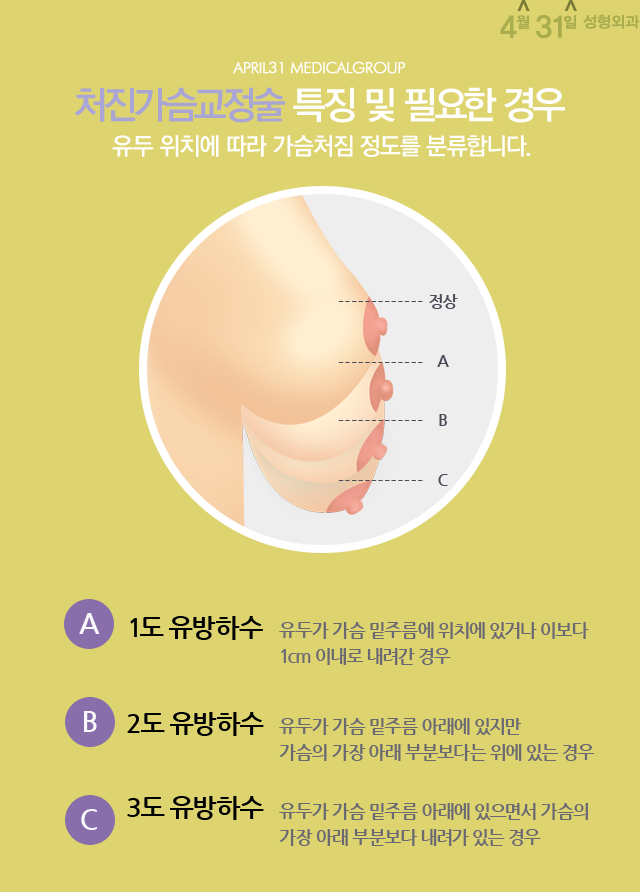처진가슴성형잘하는곳 4월31일성형외과 관련 이미지 2