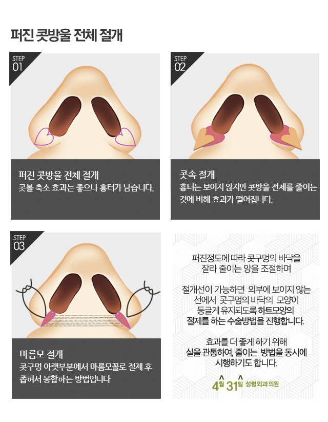 콧볼축소후기 인위적이지 않은 모양을 위해서는 관련 이미지 3