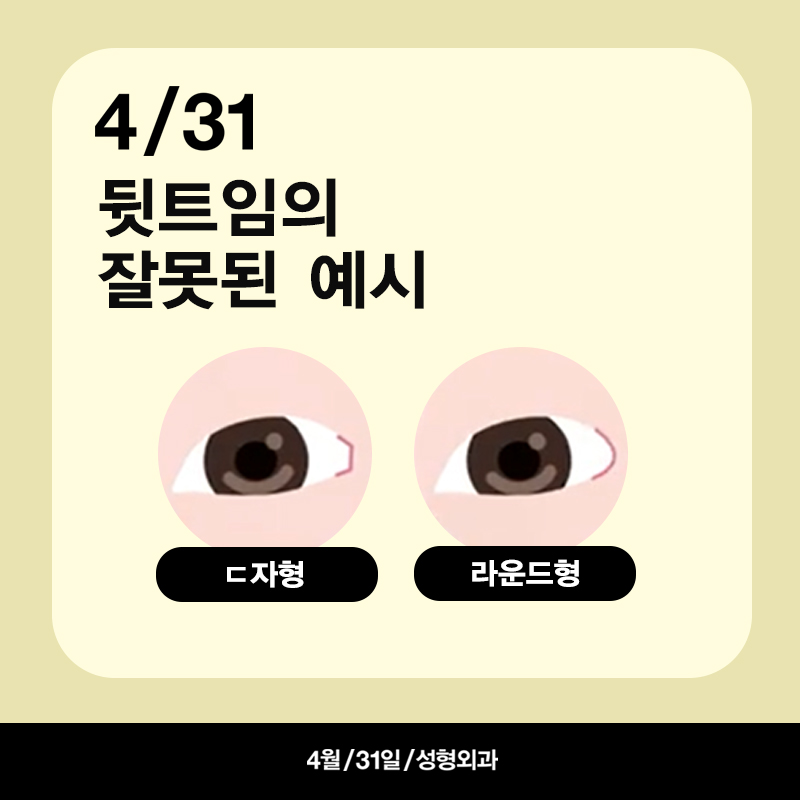 [Eye Revision Surgery] A Difference Made by a Small Detail image 7