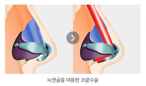 들린코재수술 이번이 마지막 4월31일성형외과의원 관련 이미지 3