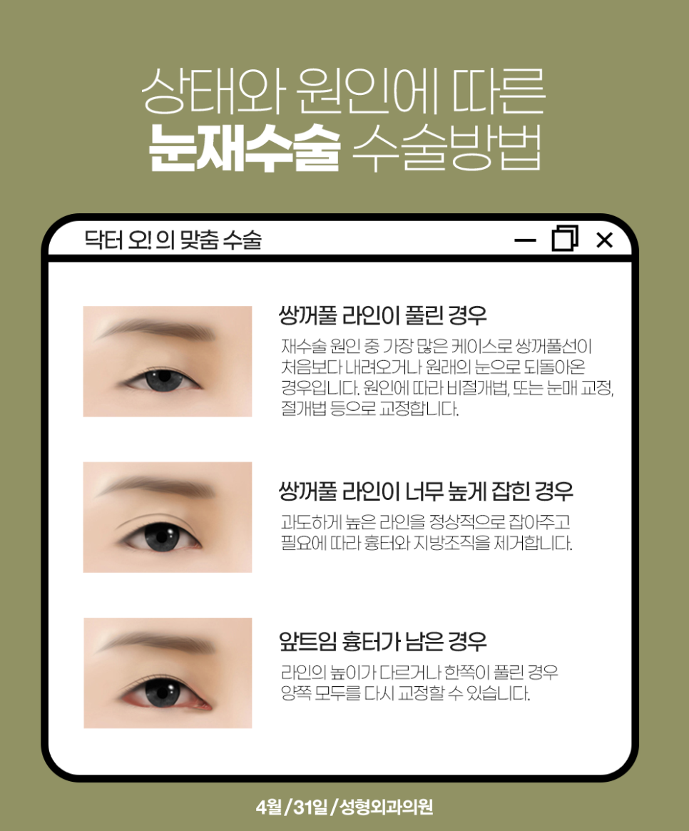 쌍꺼풀재수술유명한병원 후회없는 곳으로 관련 이미지 3