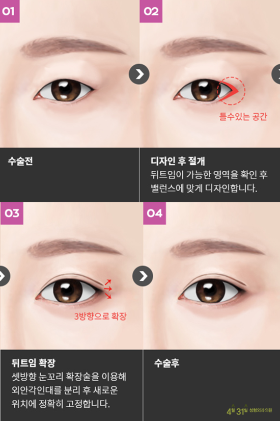 뒤트임추천 4월31일성형외과의원 관련 이미지 3