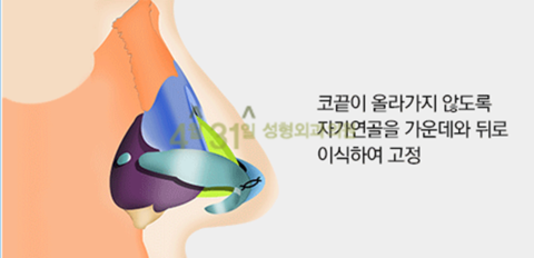 짧은코성형 4월31일성형외과의원에서 해결! 관련 이미지 4
