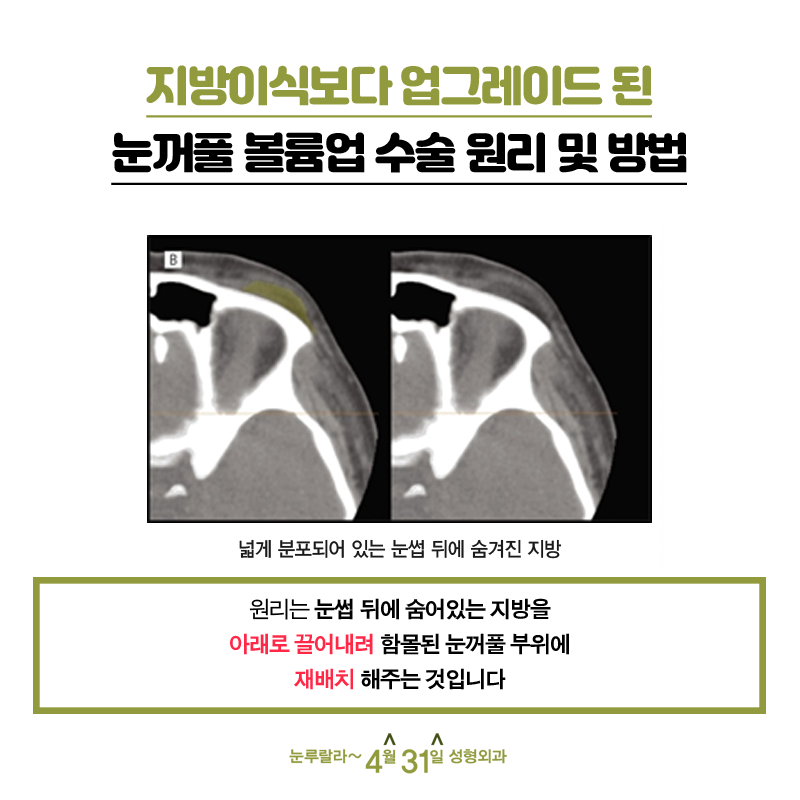 Sunken Eye Correction, April 31 Eyelid Volume Up: Bring Sunken Eyes Back to Life image 5