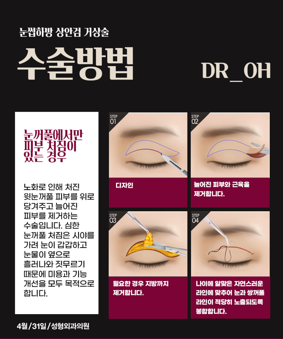 중년눈성형수술 이번 추석선물은 상안검, 하안검! 관련 이미지 2