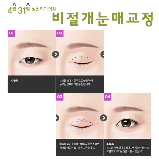 답답한눈매교정수술은 4월31일성형외과 관련 이미지 3