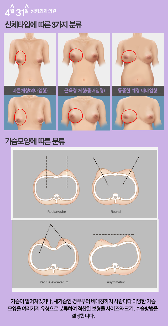 가슴구형구축 예방하는 4월31일성형외과의원 관련 이미지 3