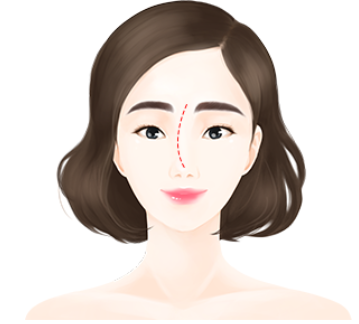 [코성형] 얼굴의 중심을 바로잡는 휜코 교정술 관련 이미지 4