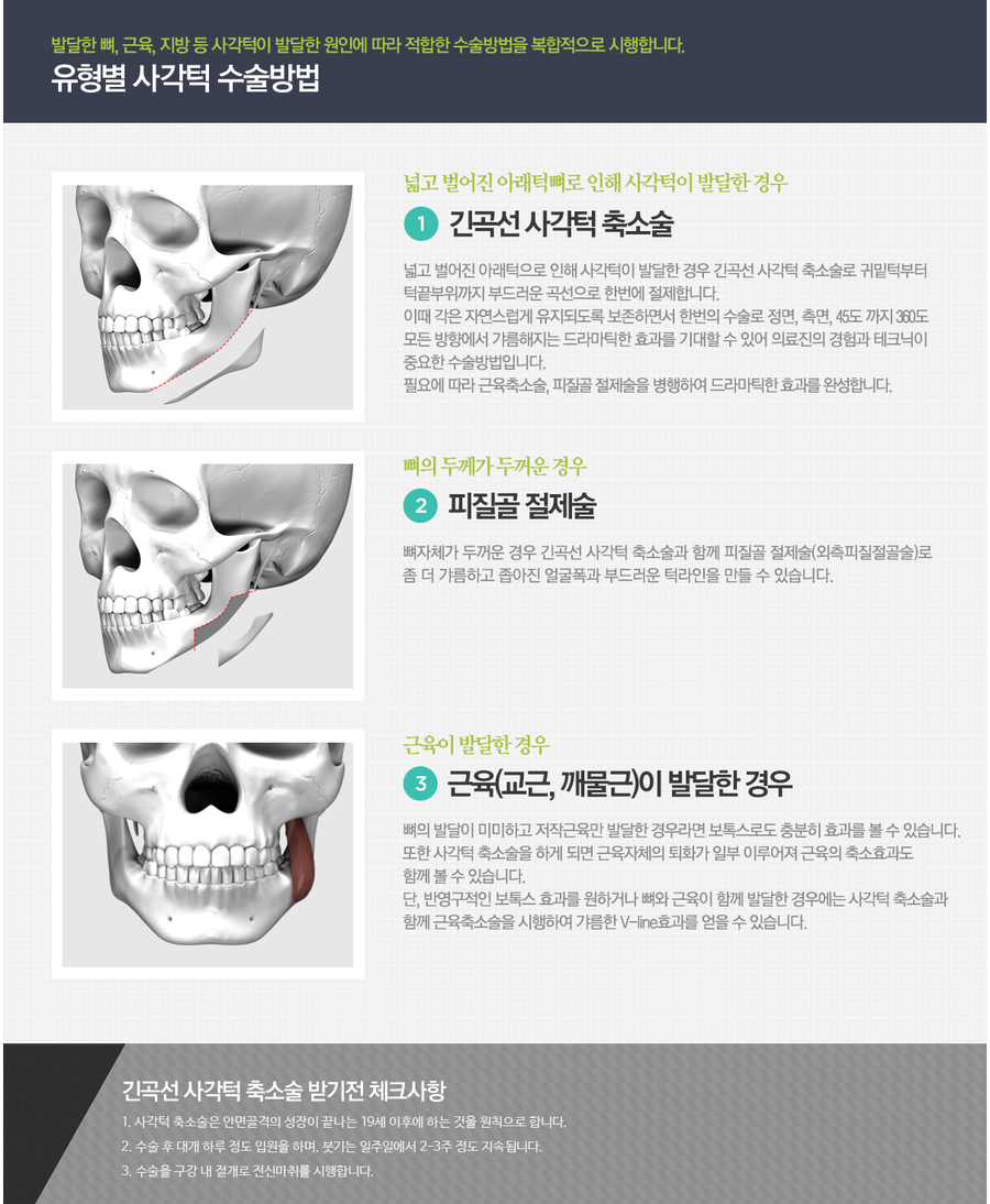 사각턱축소술 4월31일성형외과라면 성공적 관련 이미지 4