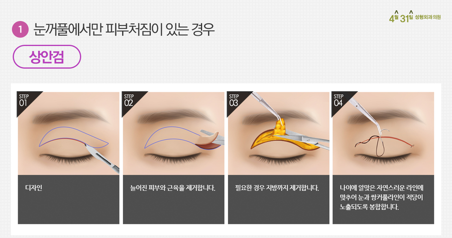 중년눈성형 상안검은 4월31일성형외과의원에서 관련 이미지 3
