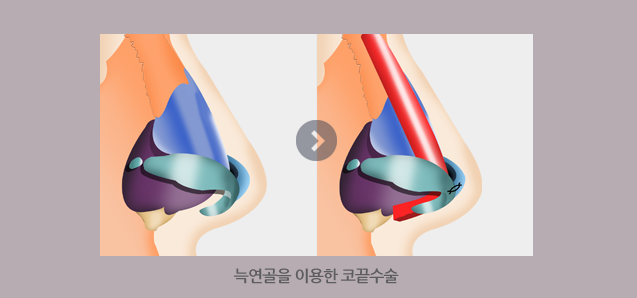구축코수술 4월31일성형외과의원에서 안전하게! 관련 이미지 2