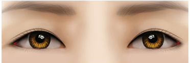[Eye Revision Surgery] A Difference Made by a Small Detail image 10