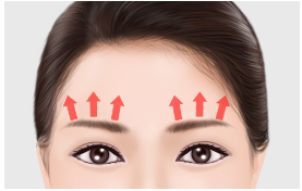 [Brow Lift] Drooping Eyebrows: Endoscopic Brow Lift for Fundamental Improvement image 4