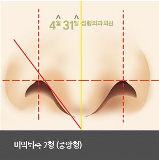 콧구멍성형 비익퇴축술 4월31일 성형외과의원에서 관련 이미지 5