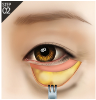 [De-Aging] Improve Under-Eye Sagging and Create a Youthful Eye Area with Aegyosal - Soup Lift image 4